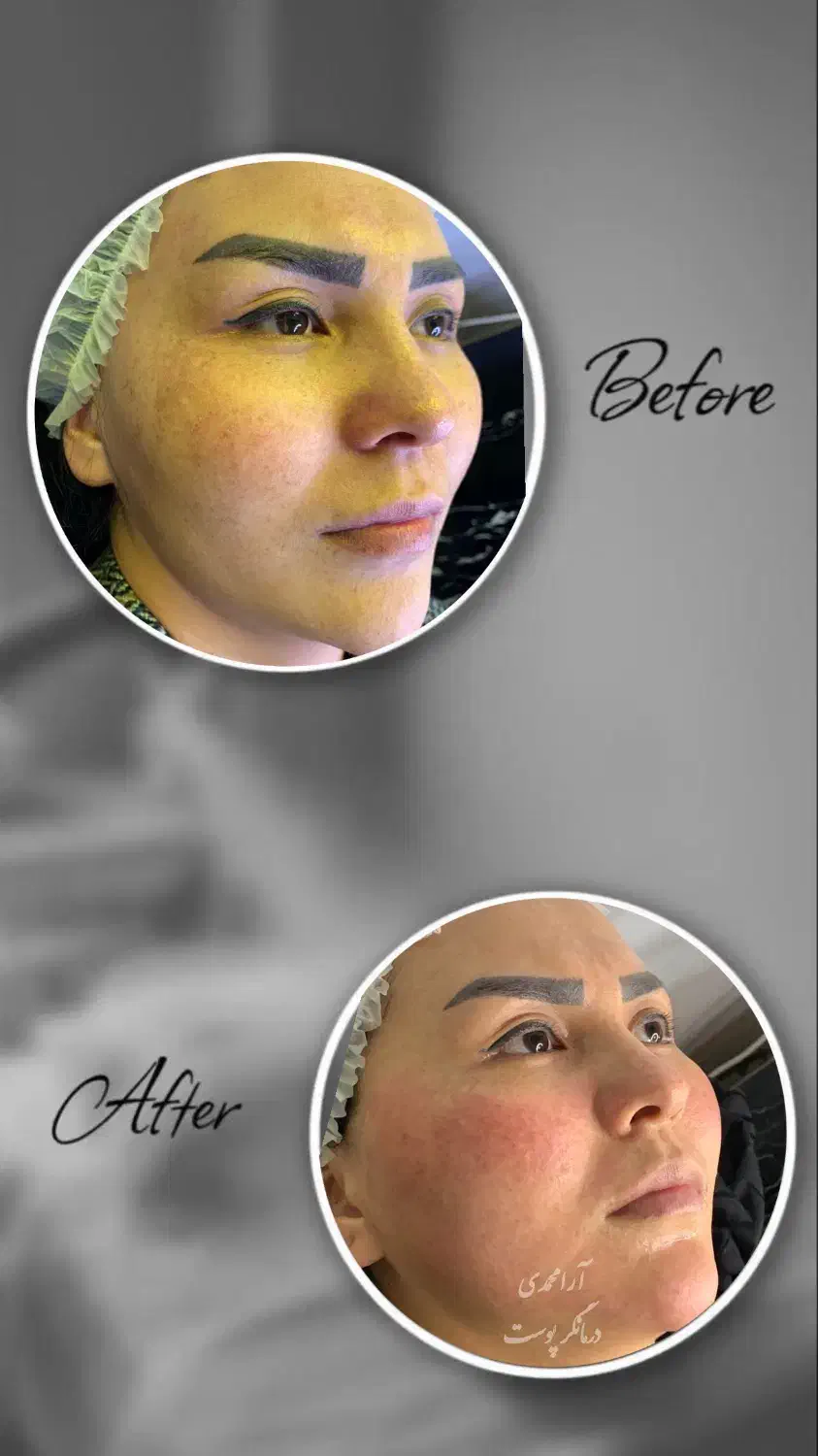 درمان پوست باتخفیف بلک فرایدی/پوست کره‌ای/کاموفلاژ|خدمات آرایشگری و زیبایی|پاکدشت, پاکدشت (مامازند)|دیوار