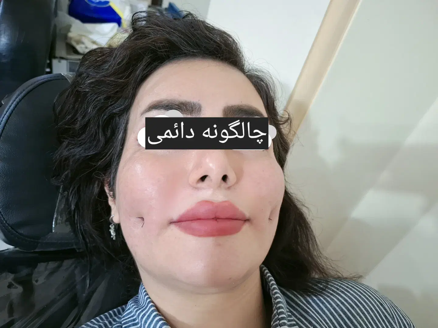 نخ فیلر|خدمات آرایشگری و زیبایی|تبریز, |دیوار