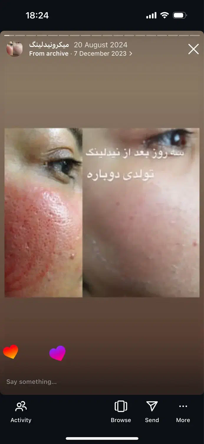 پاکسازی پوست دائمی|خدمات آرایشگری و زیبایی|قرچک, میرزائی جنوبی|دیوار