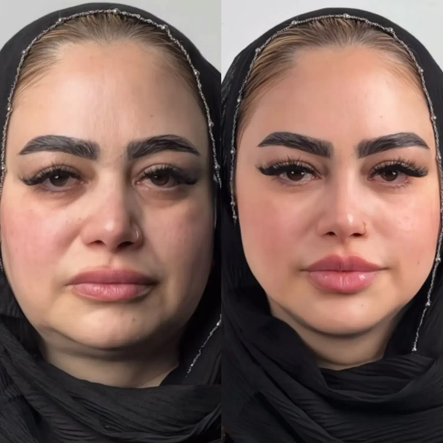 تزریق فیلر و بوتاکس در کلینیک پوست و لیزر سهرابی|خدمات آرایشگری و زیبایی|کرمانشاه, |دیوار