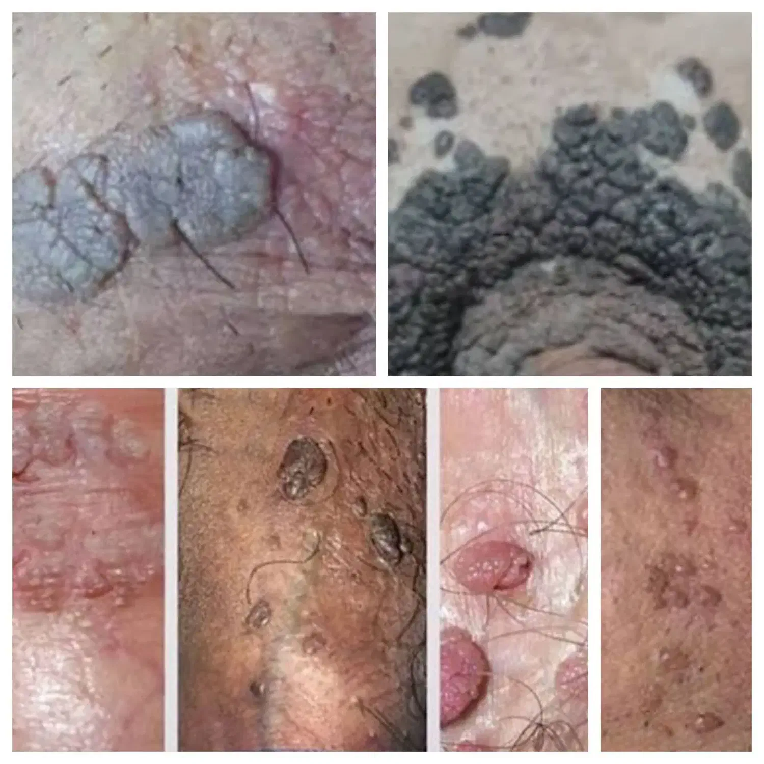 درمان قطعی و بدون بازگشت زگیل و تبخال نواحی خصوصی|خدمات آرایشگری و زیبایی|ساری, |دیوار