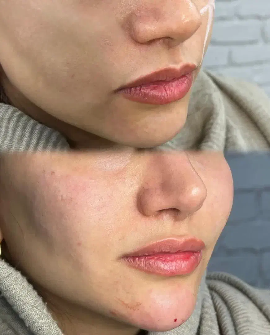 تزریق ژل وبوتاکس(سی سی ۵۰۰)ارایش دائم صورت،پیرسینگ|خدمات آرایشگری و زیبایی|آزادشهر, |دیوار