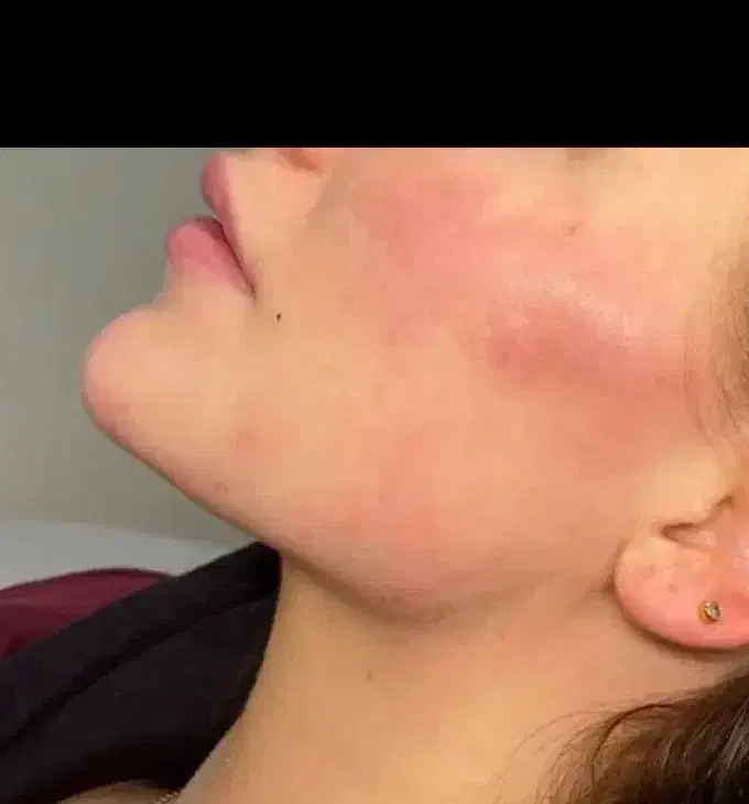 لیزرموزائدتیتانیوم ویژه روز مادر ۵۹۰تومن|خدمات آرایشگری و زیبایی|گرگان, |دیوار