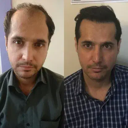 کاشت مو تنها با ۱۵ میلیون تومان|خدمات آرایشگری و زیبایی|بومهن, |دیوار