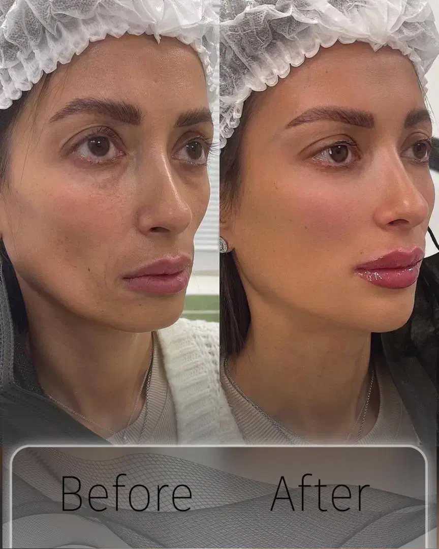 جوانسازی و لیفت بدون جراحی|خدمات آرایشگری و زیبایی|تهران, اختیاریه|دیوار