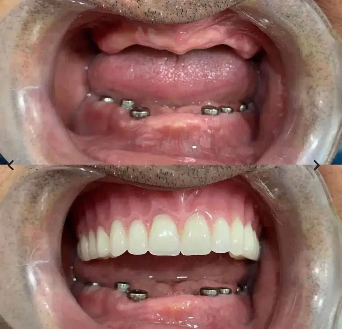 دندانپزشکی و شرایط اقساطی بدون بهره ایمپلنت|خدمات آرایشگری و زیبایی|تبریز, |دیوار