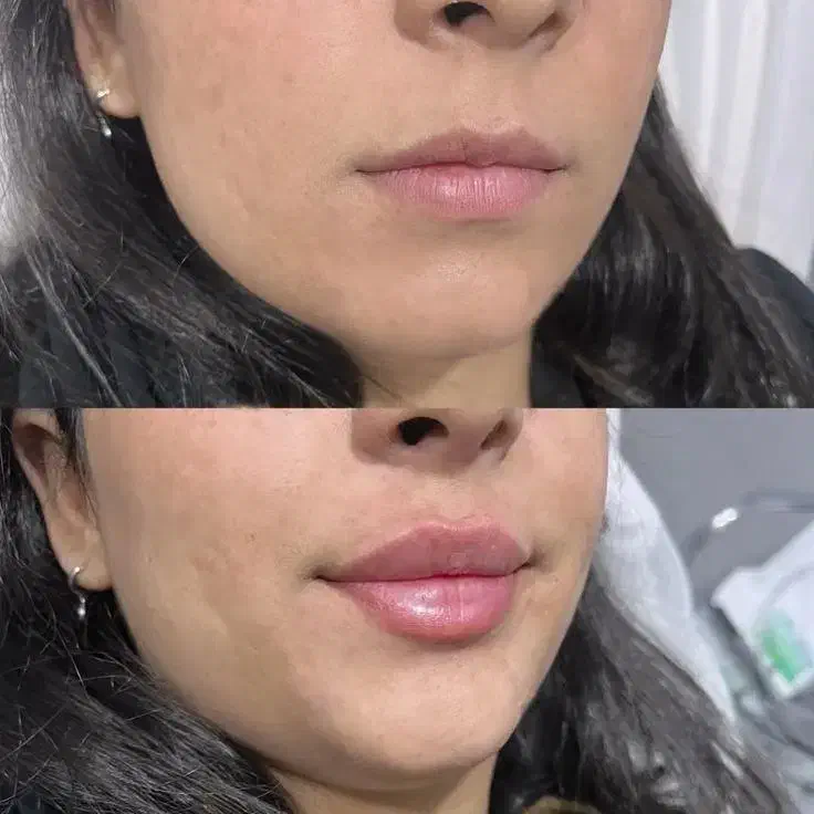 مدل فیلر بوتاکس|خدمات آرایشگری و زیبایی|سنندج, |دیوار