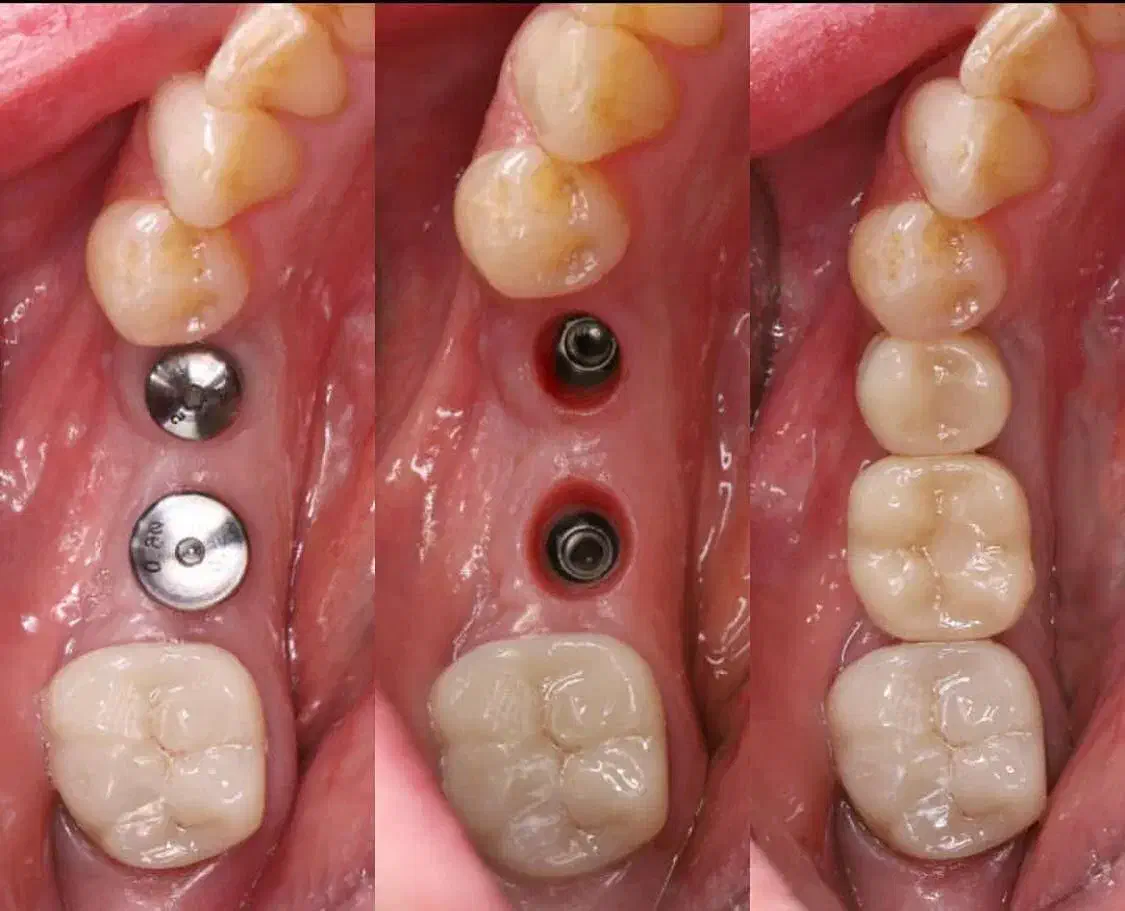 تخفیف ایمپلنت   شرایط ویژه دندانپزشکی|خدمات آرایشگری و زیبایی|اسکو, |دیوار