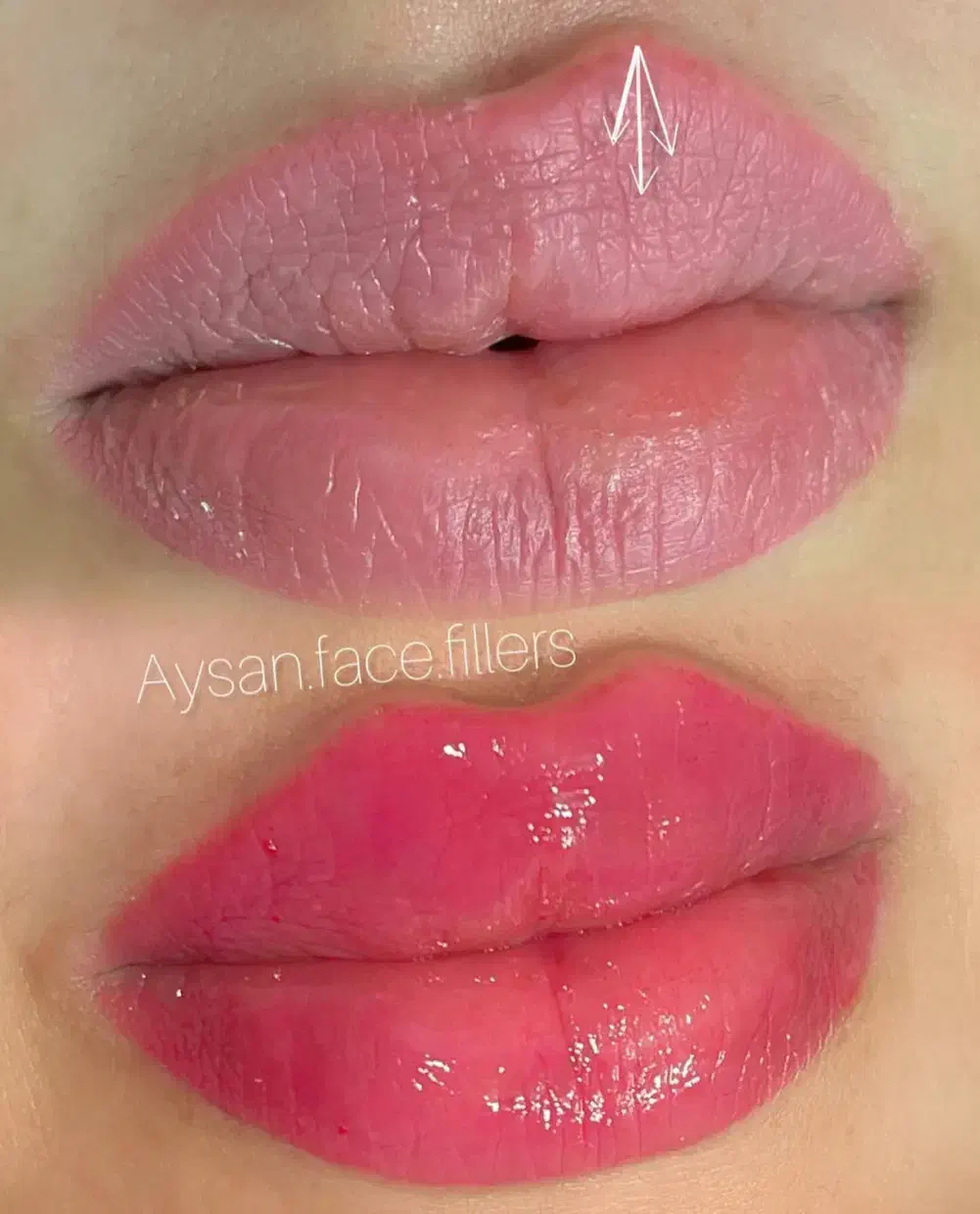 تزریق ژل و بوتاکس  تخفیف ویژه تا اخر هفته جدید|خدمات آرایشگری و زیبایی|گنبد کاووس, |دیوار