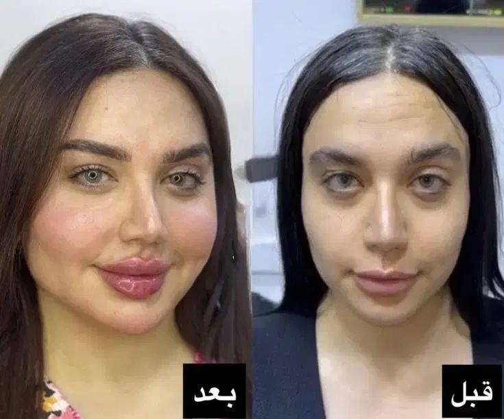 جشنواره  تزریق ژل  لب روسی وبوتاکس انزیم فیلر|خدمات آرایشگری و زیبایی|کرج, گلشهر|دیوار