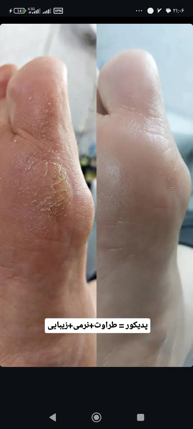 پدیکور کلینیکال درمانی|خدمات آرایشگری و زیبایی|قم, زنبیل آباد|دیوار