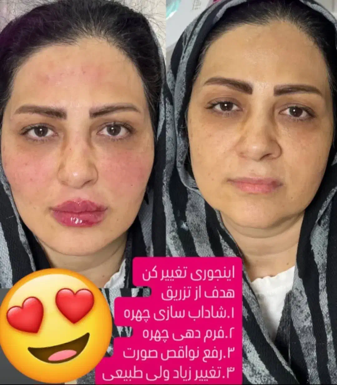 تزریق ژل و بوتاکس و مزو ژل|خدمات آرایشگری و زیبایی|فسا, |دیوار