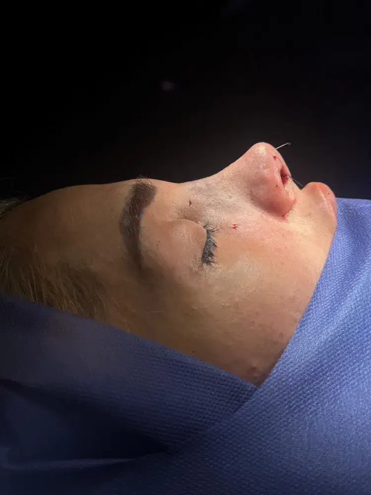 رینوپلاستی ۲۵میلیون|خدمات آرایشگری و زیبایی|قرچک, زیبا شهر|دیوار