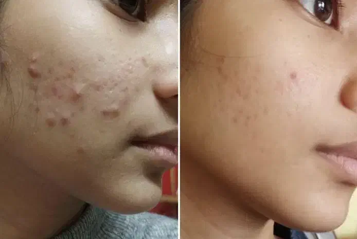 درمان جوش صورت و بدن|خدمات آرایشگری و زیبایی|دوگنبدان, |دیوار