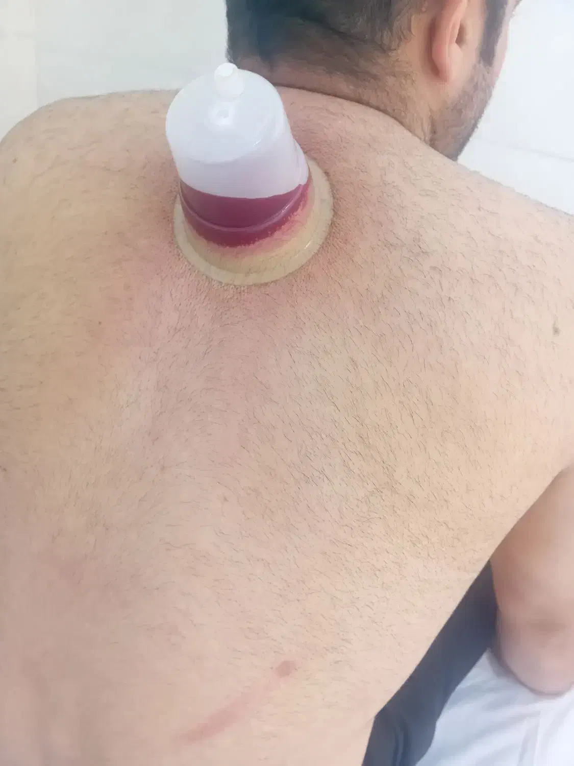 حجامت.زالودرمانی.فصد خون.بادکش|خدمات آرایشگری و زیبایی|سهند, |دیوار