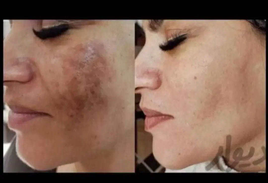 مزوندلینگ ،میکرونیلدینگ و درمان تخصصی لک|خدمات آرایشگری و زیبایی|بیرجند, |دیوار