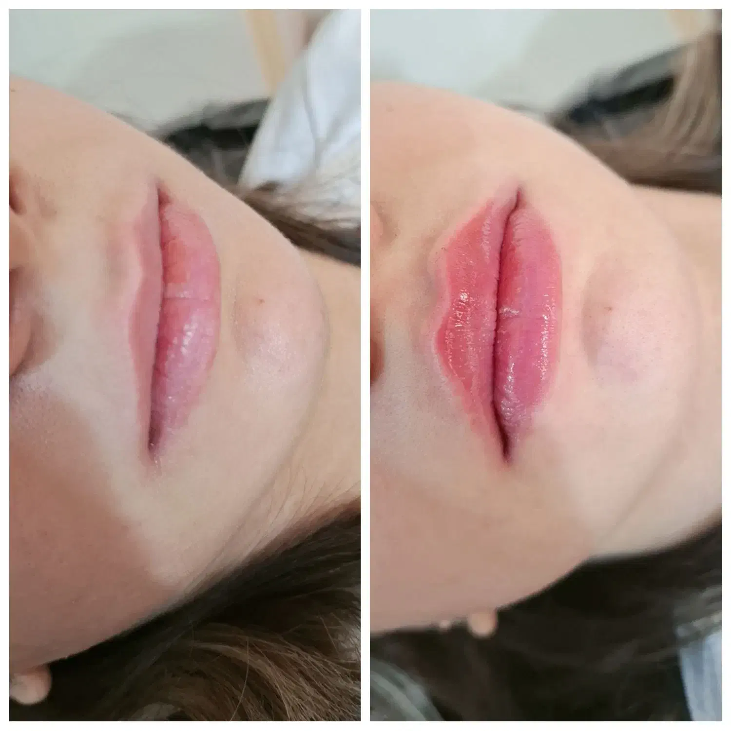 بوتاکس ژل نخ چالگونه مزو انزیم فیلر|خدمات آرایشگری و زیبایی|تبریز, |دیوار