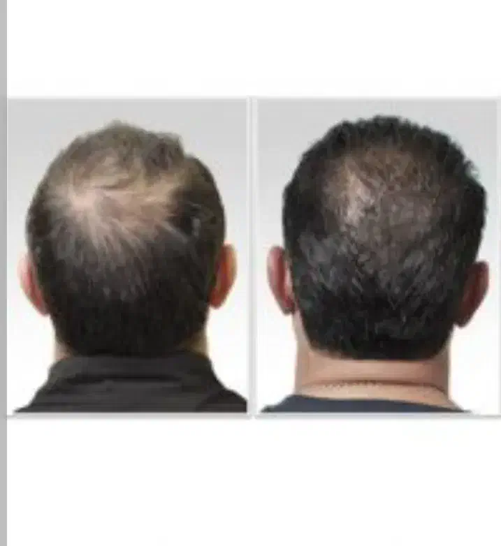 خدمات پی آر پی(PRP)پوست و مو و مزوتراپی اگزوزوم|خدمات آرایشگری و زیبایی|اصفهان, دشتستان|دیوار