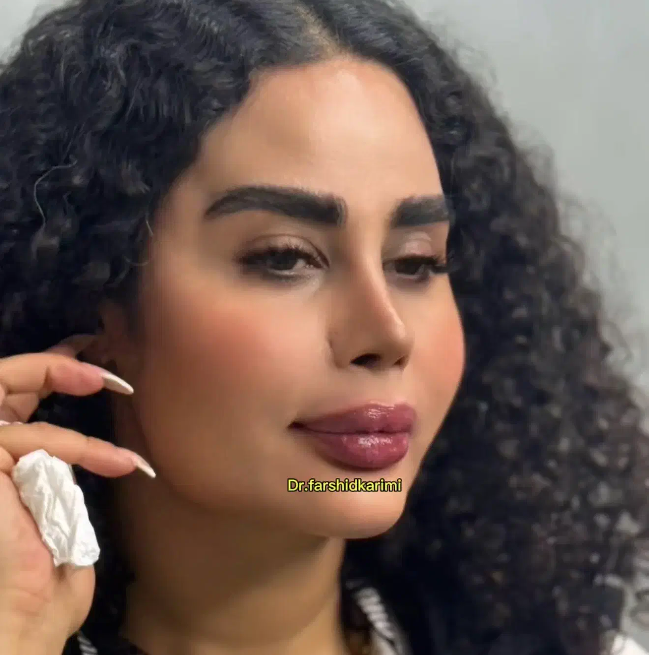 ژل و بوتاکس کلینیک زیبایی دکترفرشیدکریمی|خدمات آرایشگری و زیبایی|کرمانشاه, |دیوار