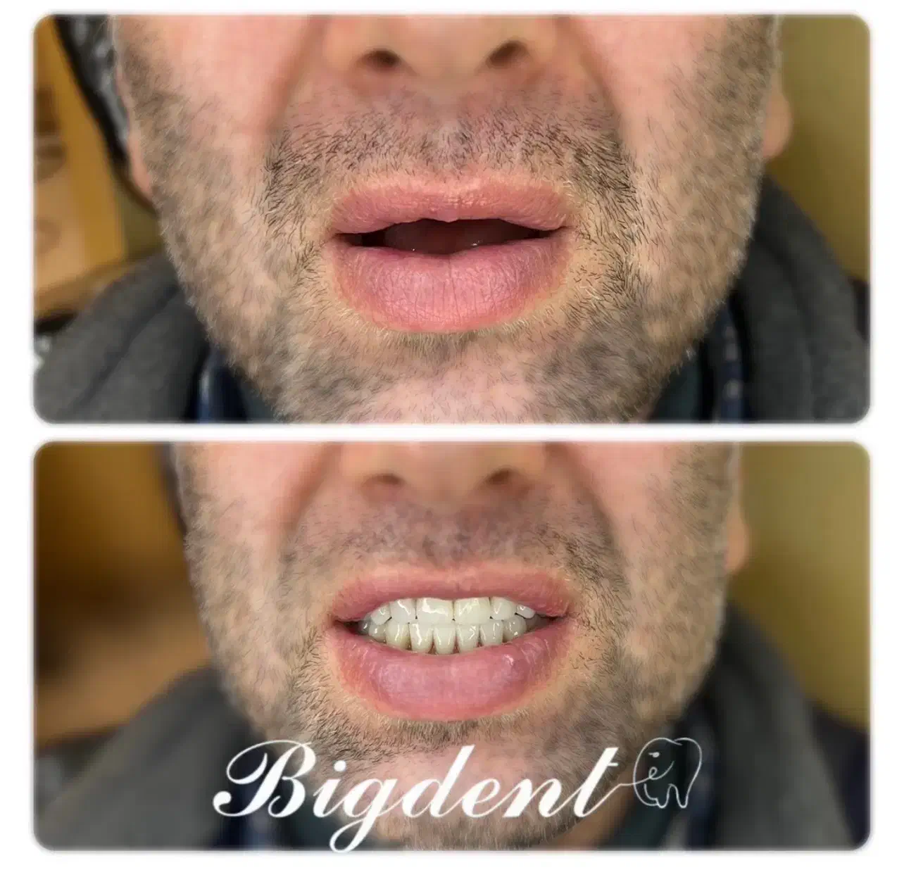 دندان مصنوعی تخفیف تا شب یلدا برای ۵ نفر قیمت ویژه|آرایشی، بهداشتی، درمانی|تبریز, |دیوار