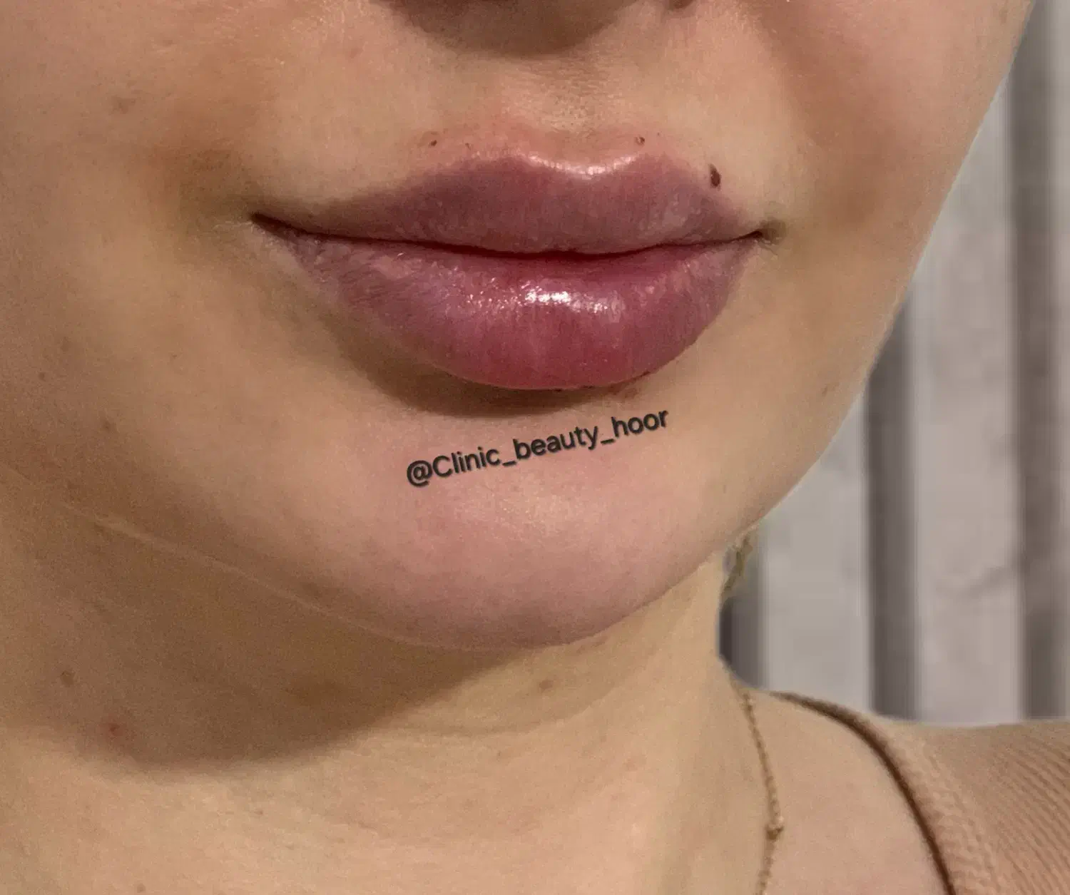 جشنواره تزریق ژل و فیلر بوتاکس مزوتراپی (پزشک)|خدمات آرایشگری و زیبایی|سنندج, |دیوار