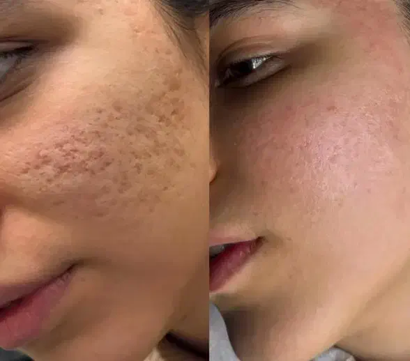 مزو ندلینگ|خدمات آرایشگری و زیبایی|مشهد, دانشجو|دیوار