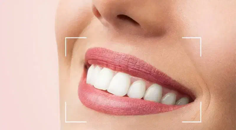 لبخندتان زیبا ، با شرایط استثنایی مهر|خدمات آرایشگری و زیبایی|لار, |دیوار