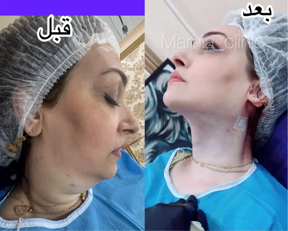 تزریق ژل و بوتاکس-چربی|خدمات آرایشگری و زیبایی|اهواز, کیانپارس |دیوار