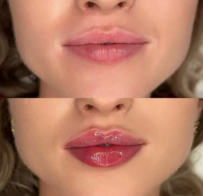 تزریق ژل (فیلر)وبوتاکس لیفت با نخ‌ مادلینگ درشرق|خدمات آرایشگری و زیبایی|تهران, هفت حوض|دیوار