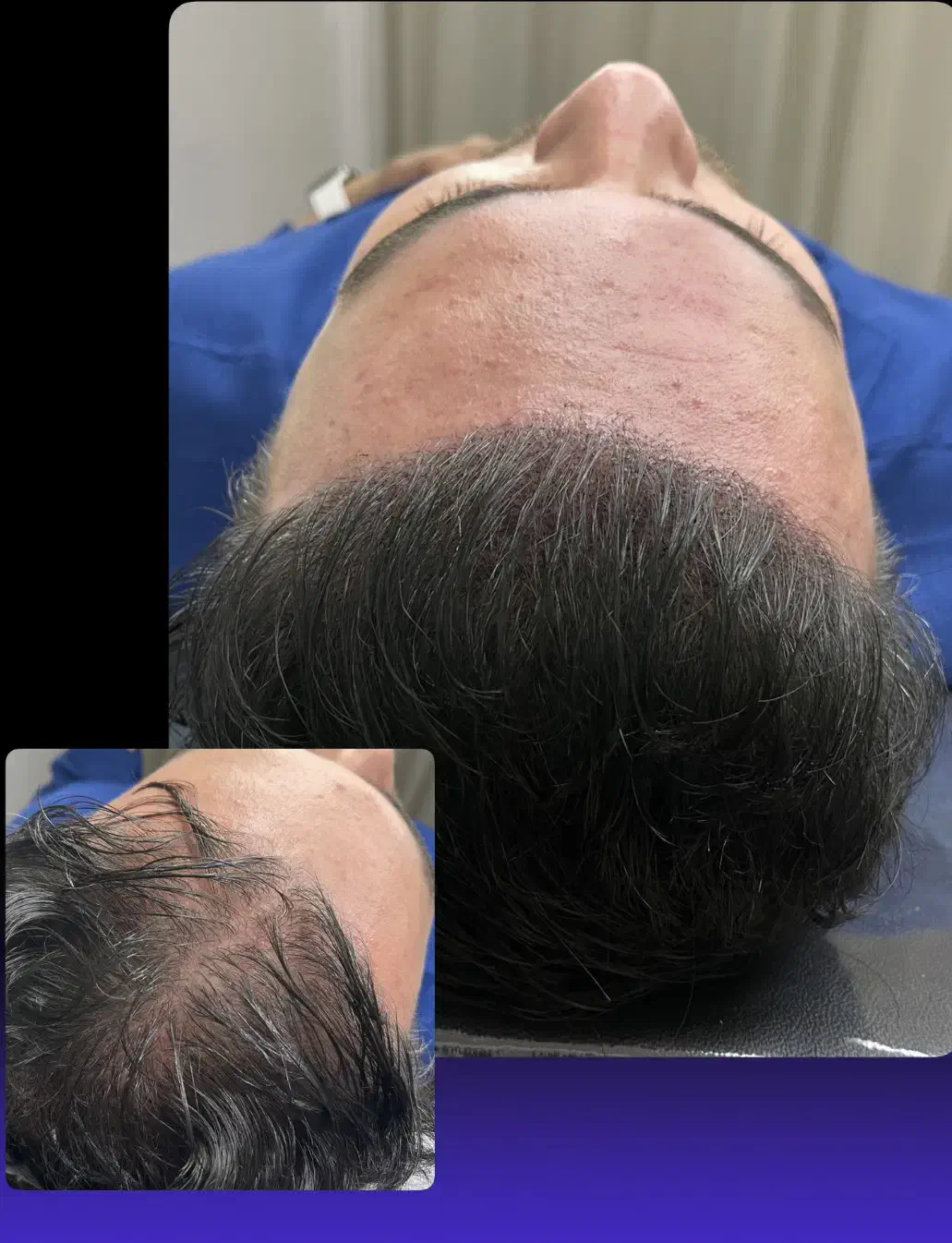 میکرواسکالپ اسکراپ کاشتمو درمجموعه زیبانو|خدمات آرایشگری و زیبایی|مشهد, گوهرشاد|دیوار