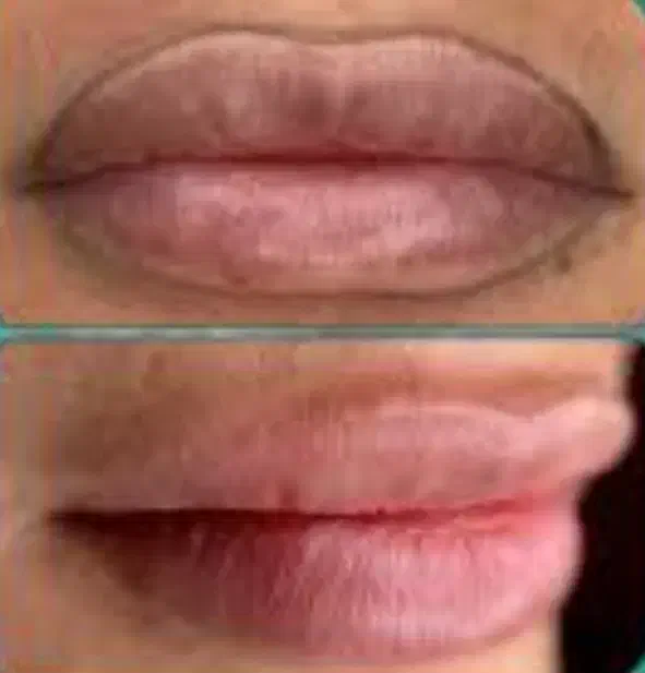 ریموو و پاک کردن تخصصی تاتو توسط مستر ریموو|خدمات آرایشگری و زیبایی|تهران, دهکده المپیک|دیوار