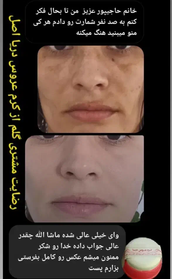 کرم ضد لک قوی عروس دریا|آرایشی، بهداشتی، درمانی|بناب, |دیوار