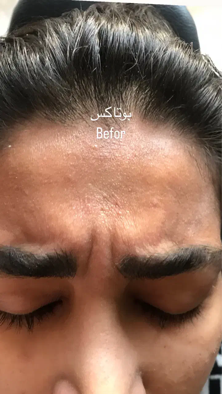 پاکسازی و فیشیال پوست  ازبین بردن لک مخصوص بانوان|خدمات آرایشگری و زیبایی|آمل, |دیوار