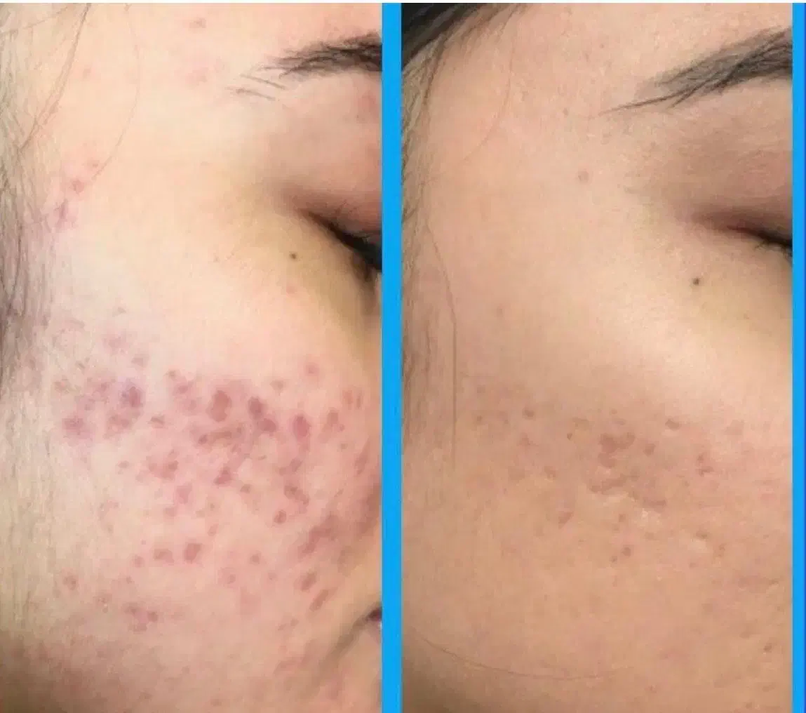 فشیال تخصصی vip پوست به مدت 3 روز فقط 170 تومن|خدمات آرایشگری و زیبایی|مشهد, آزادشهر|دیوار