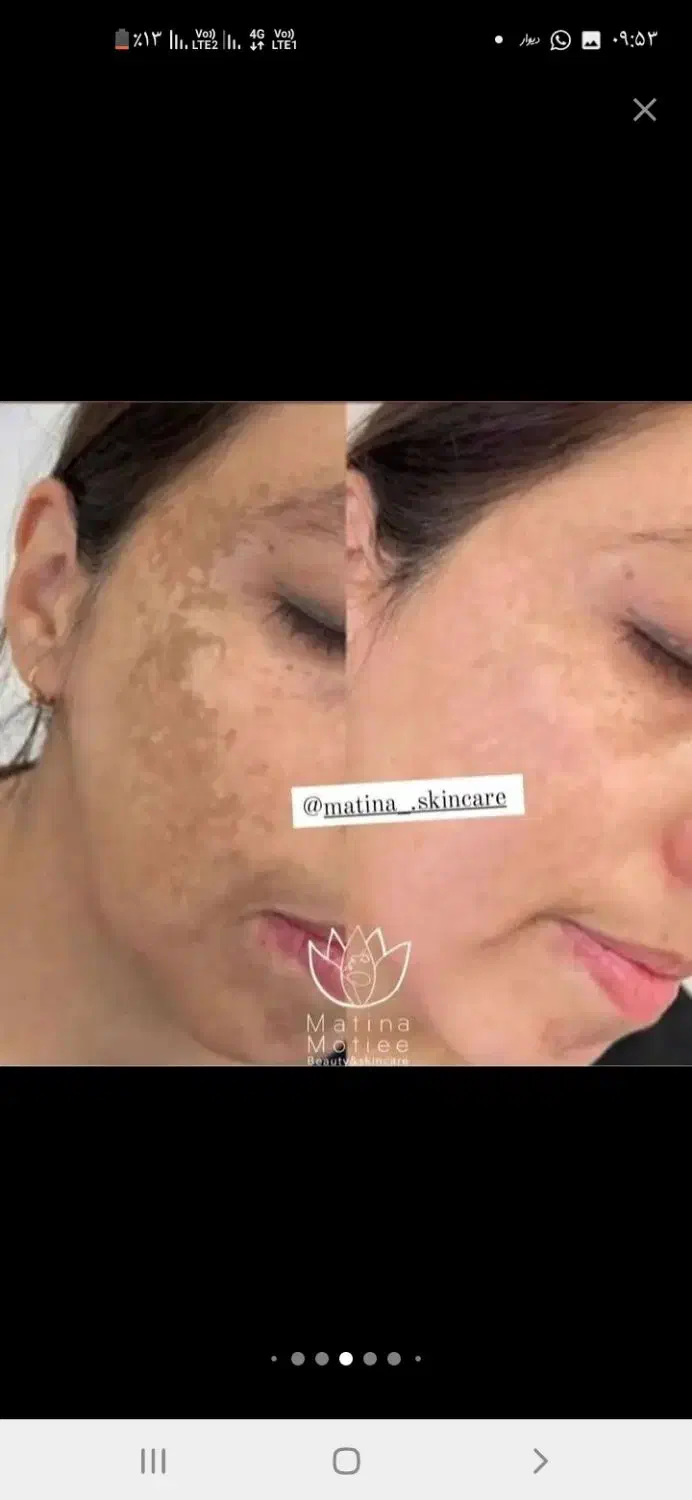 فیشال تخصصی، برداشت خال و ککو مک، ژل و بوتاکس|خدمات آرایشگری و زیبایی|شاهرود, |دیوار