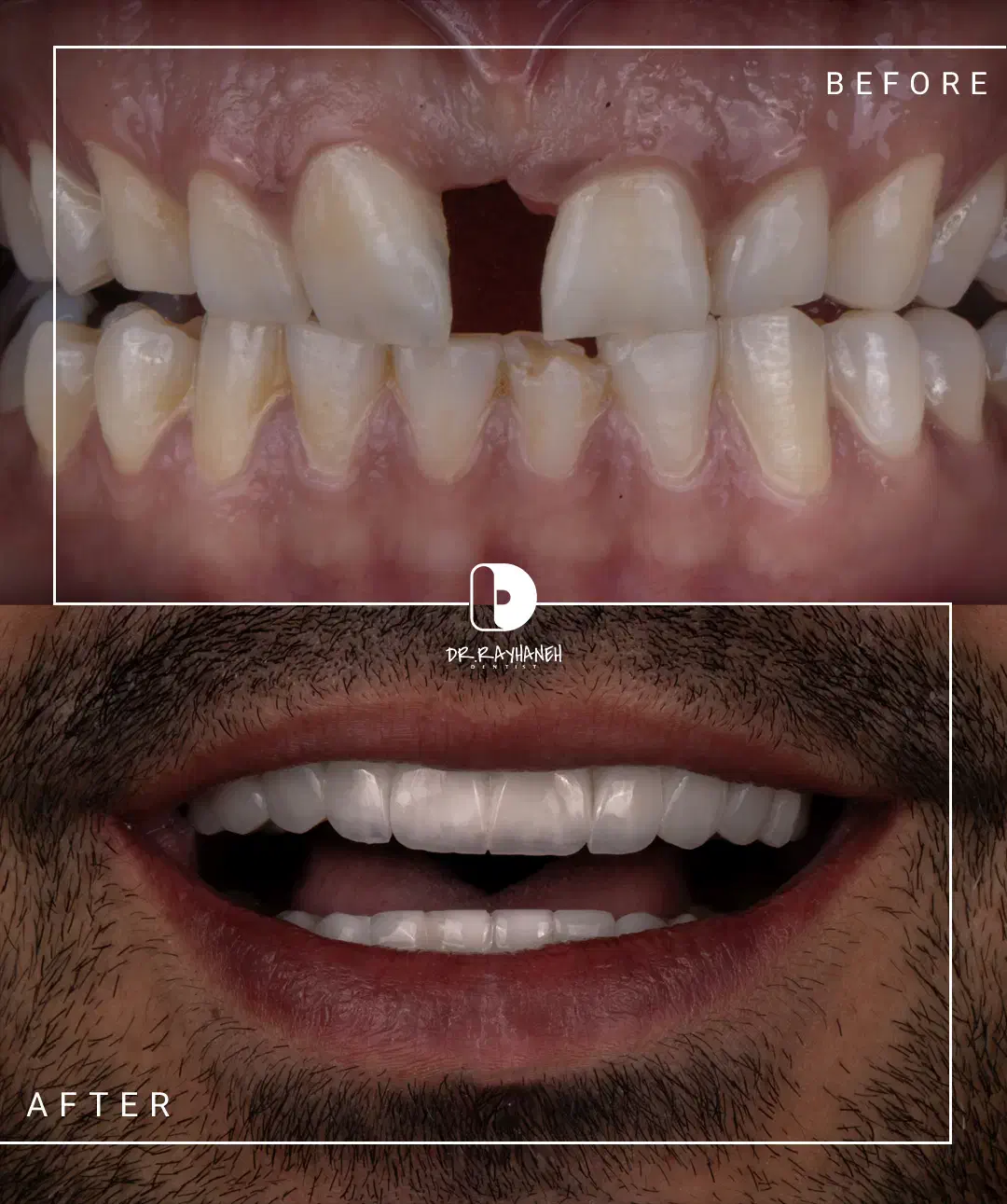 کامپوزیت/لمینت/دندانپزشکی|خدمات آرایشگری و زیبایی|مشهد, کوثر|دیوار