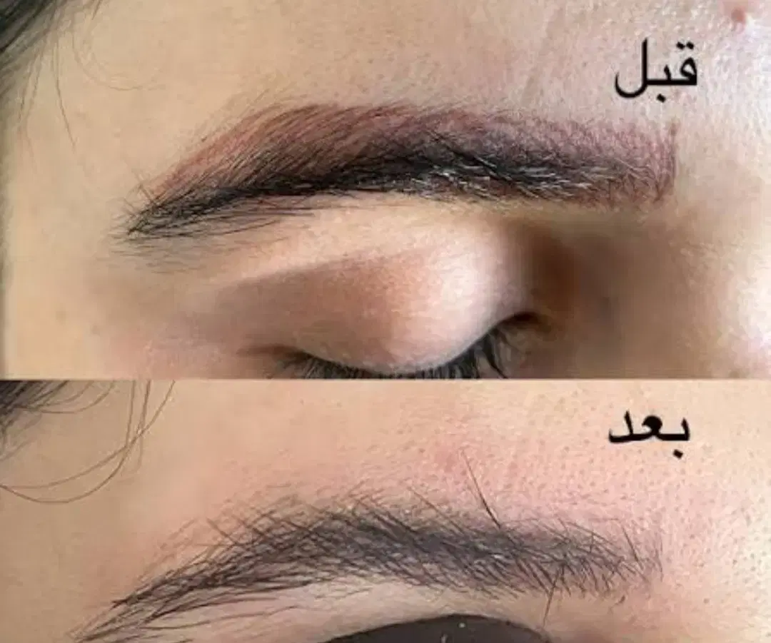 تخفیفات پاککردن تتو صورت وبدن|خدمات زیبایی و سلامت|کرمانشاه, |دیوار