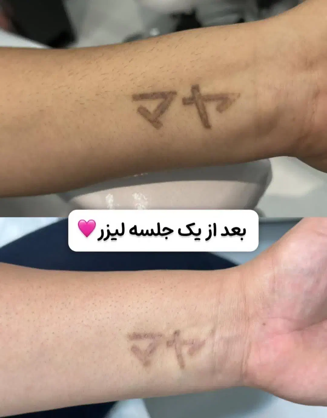 بلفاروپلاستی، پاک کردن تتو، ژل لب، وایتنینگ پوست|خدمات آرایشگری و زیبایی|باقرشهر, |دیوار