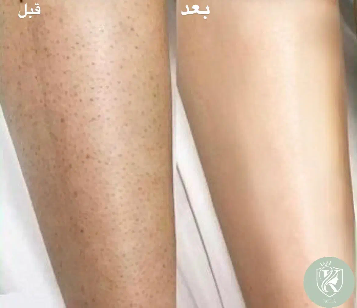 لیزر موهای زائد با آخرین تکنولوژی دستگاه|خدمات آرایشگری و زیبایی|تهران, زعفرانیه|دیوار