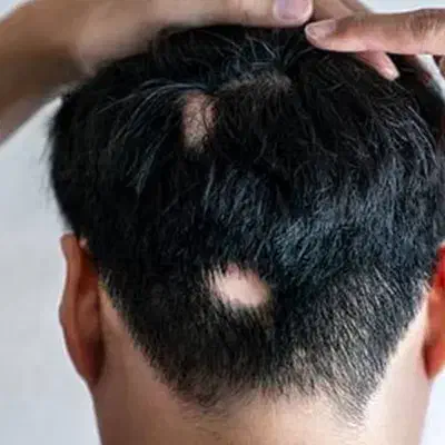 ریزش موی سکه ای|آرایشی، بهداشتی، درمانی|میناب, |دیوار