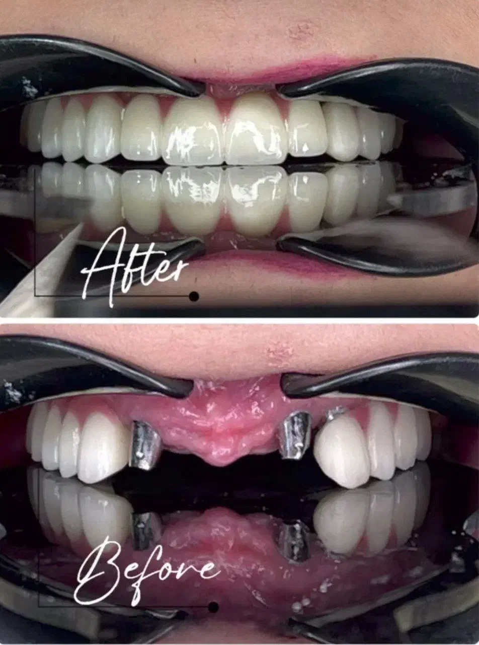 مرکز تخصصی دندانپزشکی ایمپلنت آلمانی(اقساط ۱۲ماهه)|خدمات آرایشگری و زیبایی|تبریز, |دیوار