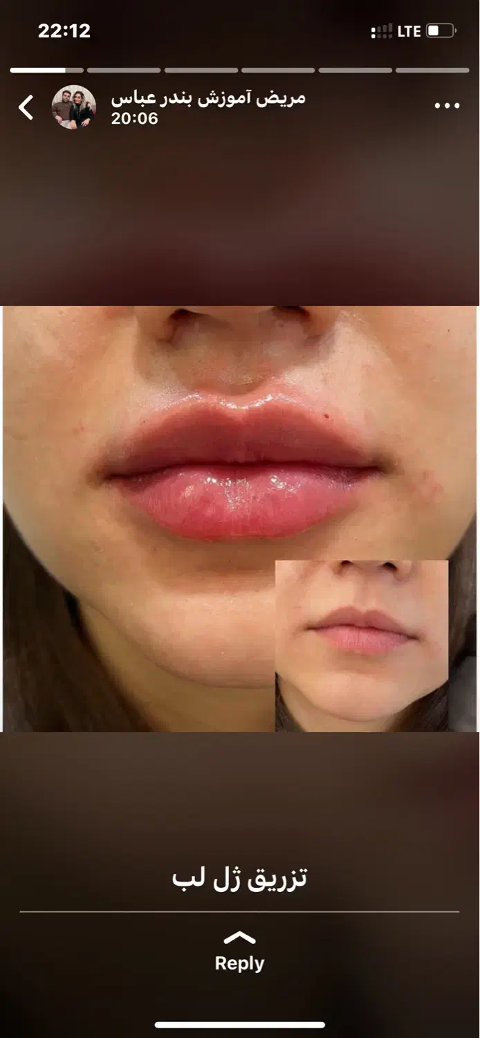 آموزش تخصصی ژل و بوتاکس|خدمات آموزشی|تهران, تهرانپارس شرقی|دیوار