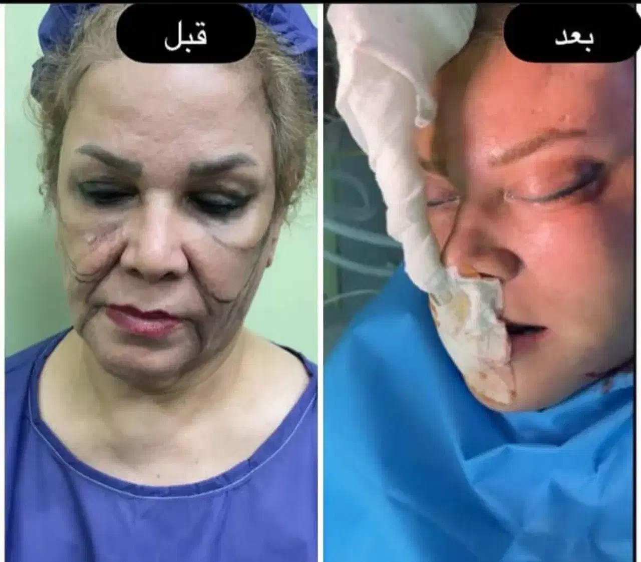 لیفت شقیقه ،بلفارو ،غبغب وغیره|خدمات آرایشگری و زیبایی|اهواز, کیانپارس |دیوار
