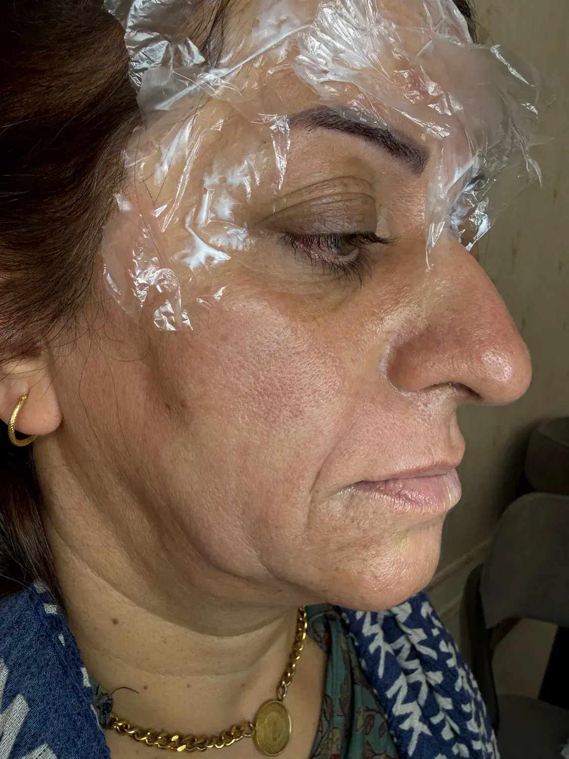 ژل و بوتاکس|خدمات آرایشگری و زیبایی|قاسم‌آباد (خواف), |دیوار