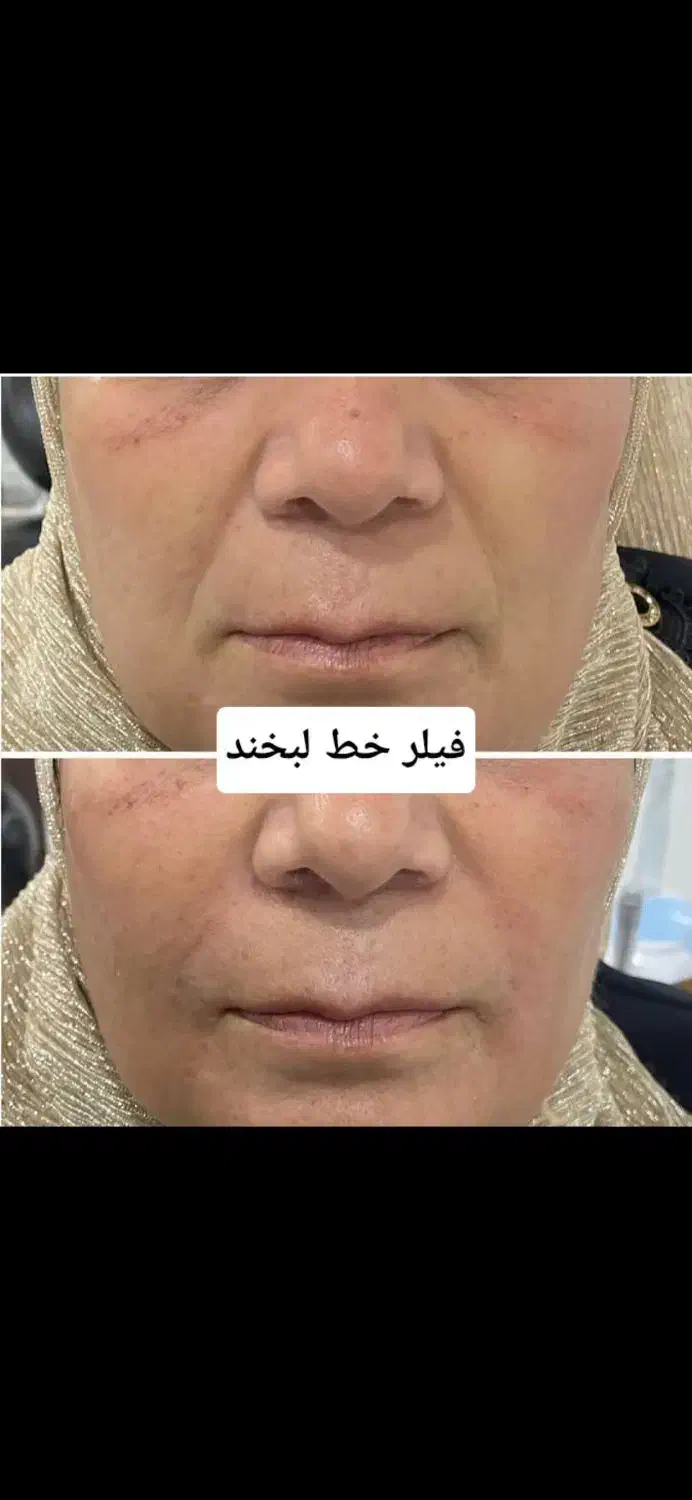 آف ویژه فیلر ، بوتاکس ، مزو ، نخ ، پی آر پی|خدمات آرایشگری و زیبایی|شیراز, قصرالدشت|دیوار