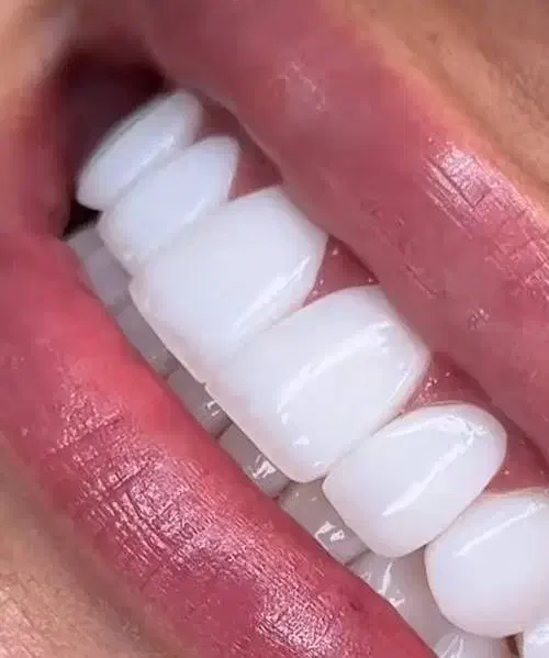 خدمات دندانپزشکی و زیبایی چکی|خدمات آرایشگری و زیبایی|ساری, |دیوار