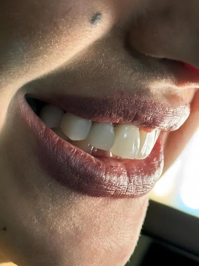 اصلاح لبخند بدون آسیب مشاوره رایگان|خدمات آرایشگری و زیبایی|شیراز, نشاط|دیوار