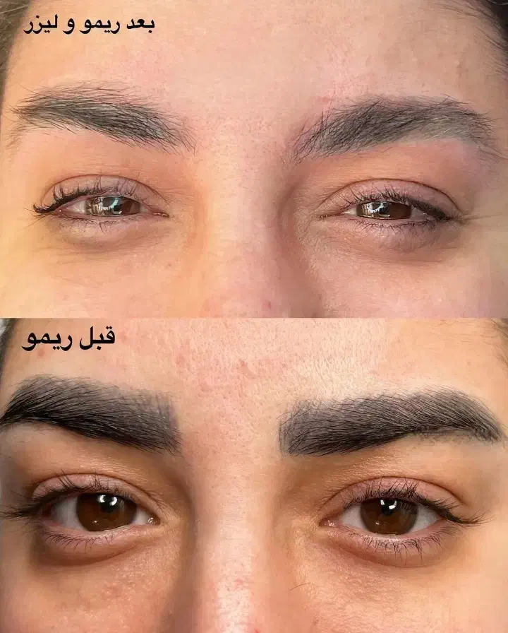 جشنواره‌ تخصصی ریموو تتو با دستگاه فوق‌ پیشرفته|خدمات آرایشگری و زیبایی|دزفول, |دیوار