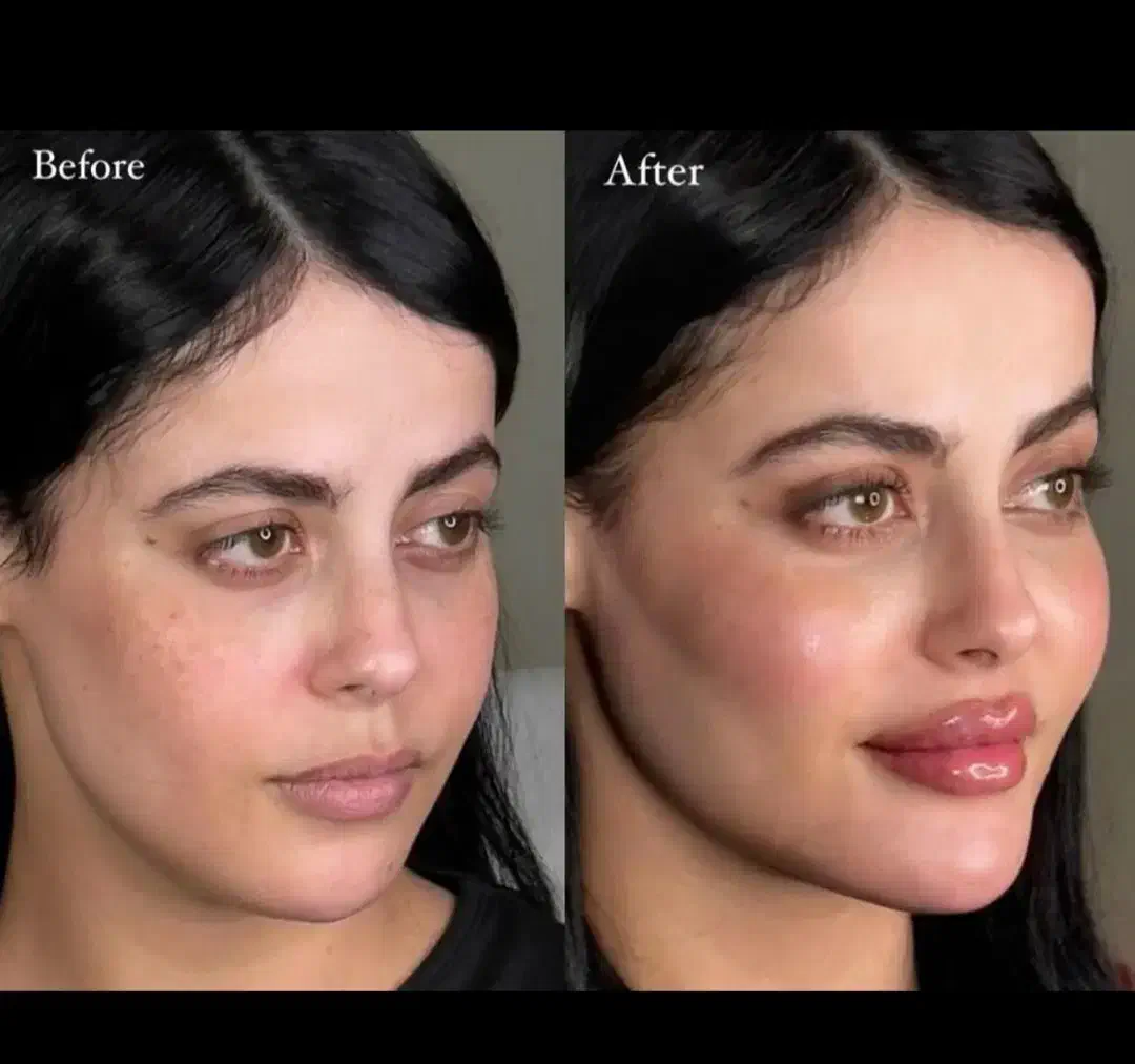 بوتاکس وفیلر صورت و بدن|خدمات آرایشگری و زیبایی|بیرجند, |دیوار