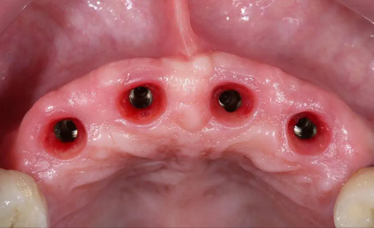 دندانپزشکی اوردنچر دو فک فقط ۱۰۰ تومن|خدمات آرایشگری و زیبایی|هریس, |دیوار